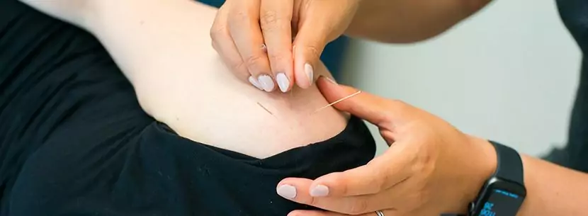 acupuncturist performing dry needling