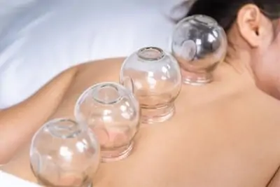 cupping therapy rmt emkiro toronto